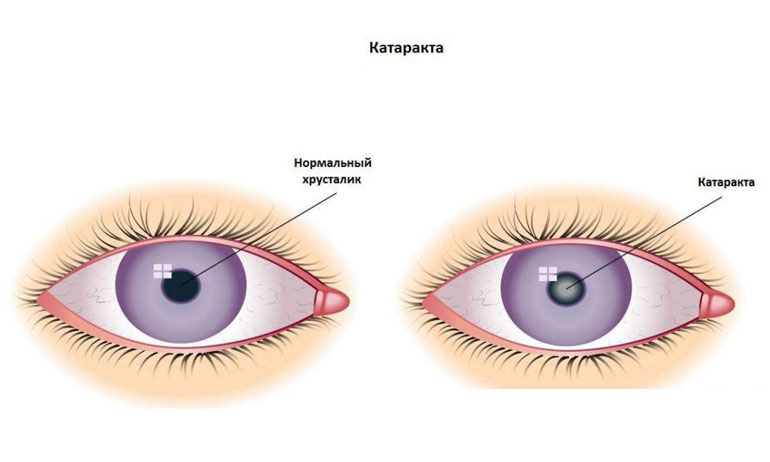современные средства лечения гипертонии катаракты