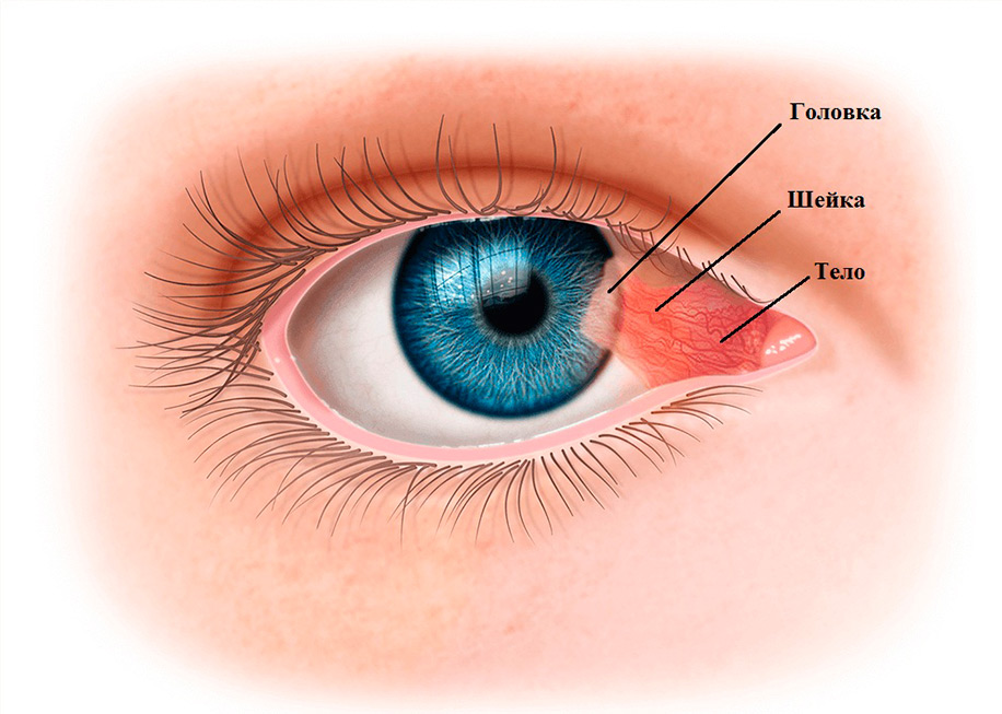 Глазное Яблоко Нарост Фото