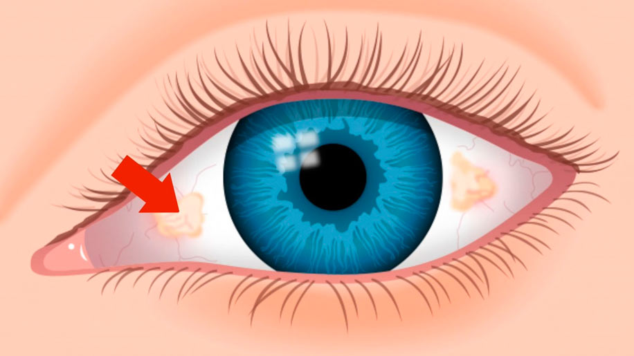 Симптомы, причины, диагностика и лечение пингвекулы глаза