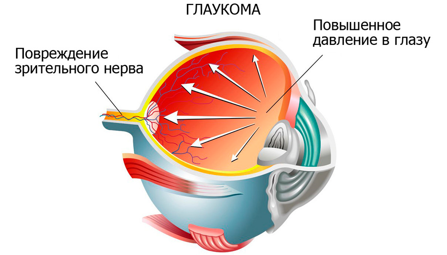 Электронная тонография при глаукоме