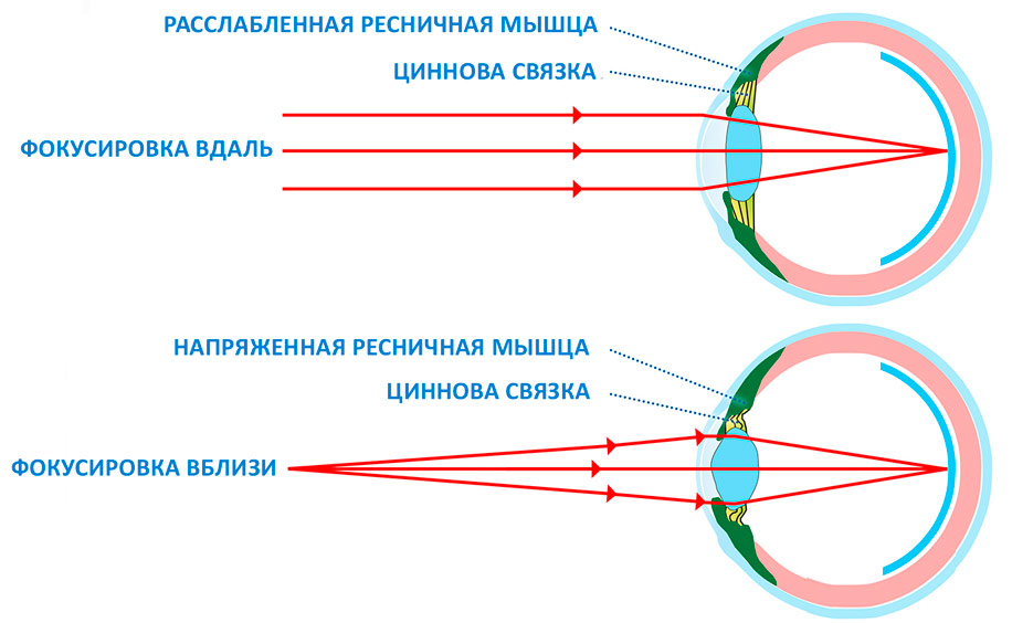 Расфокусировка зрения и головная боль после