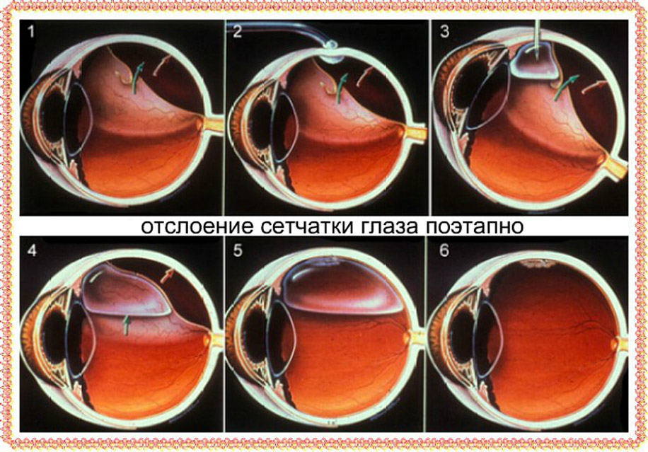 Отслоение сетчатки причины симптомы лечение