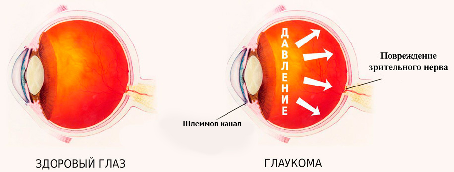 Побочное действие сужение полей зрения