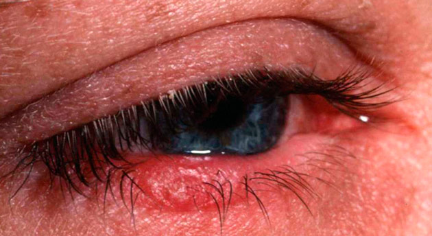 Блефарит глаза симптомы и лечение