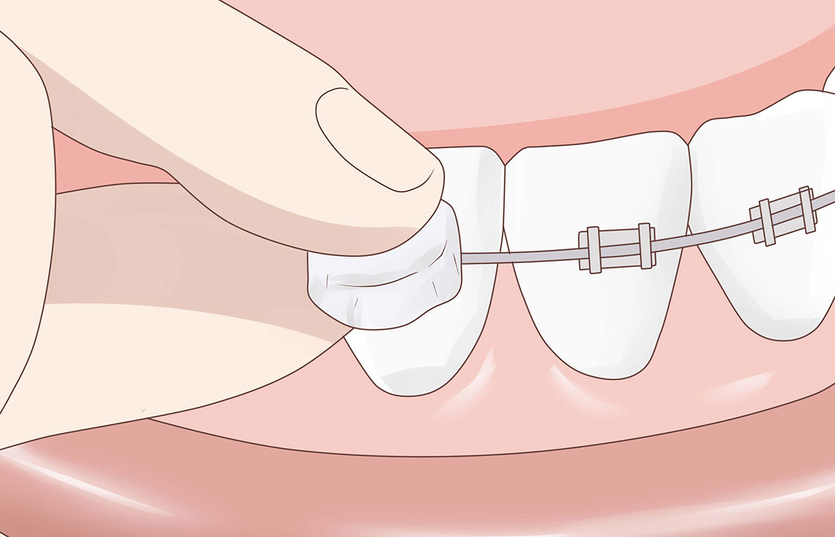 Ортодонтический воск