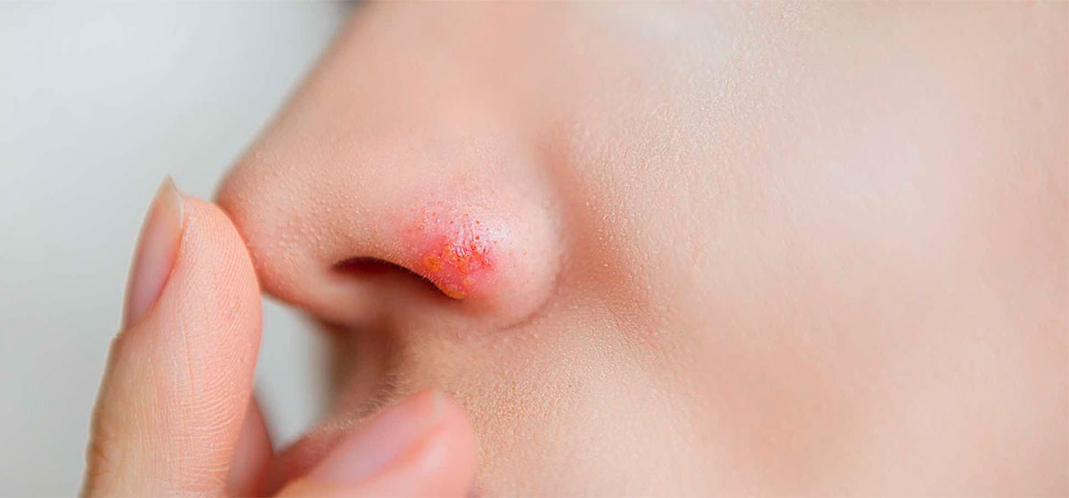 Como curar heridas en la nariz por dentro