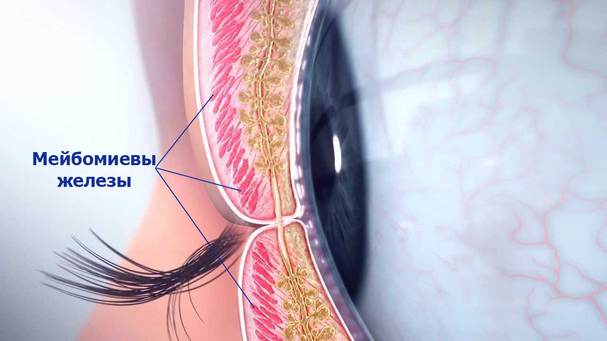При заднем хроническом блефарите воспаляются выводные протоки в мейбомиевых железах.