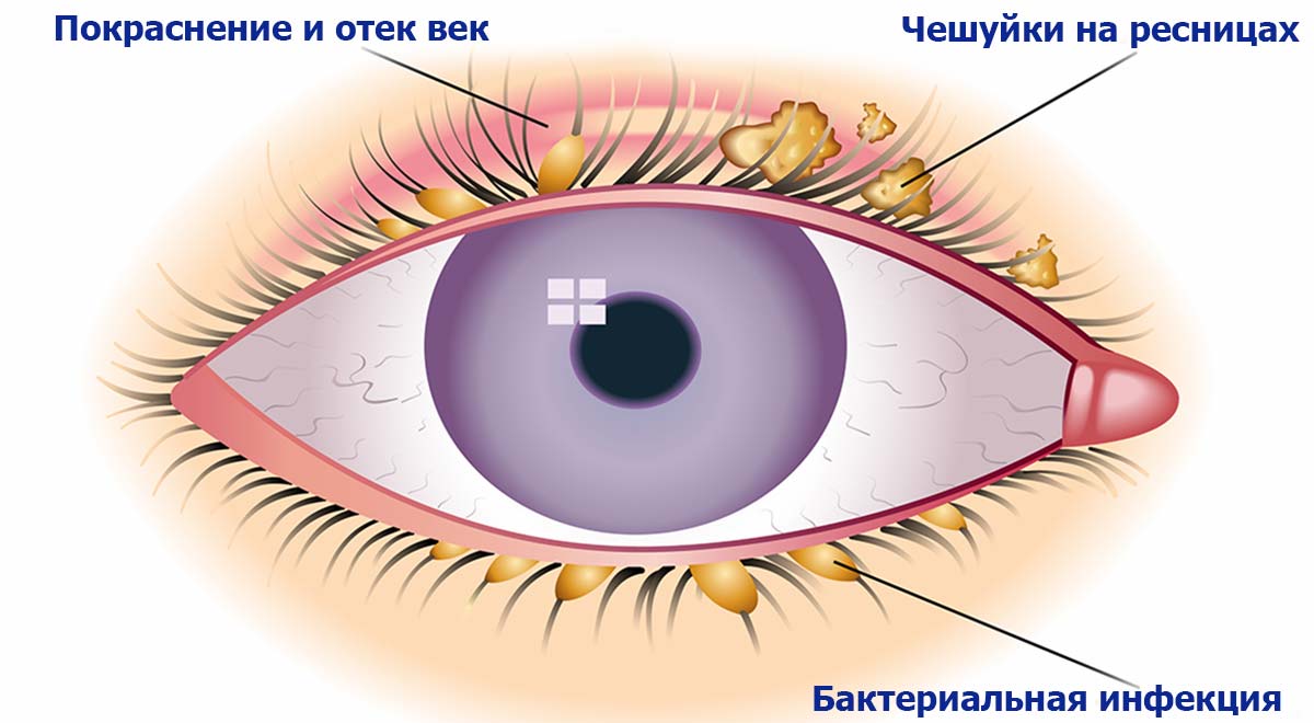 Симптомы блефарита