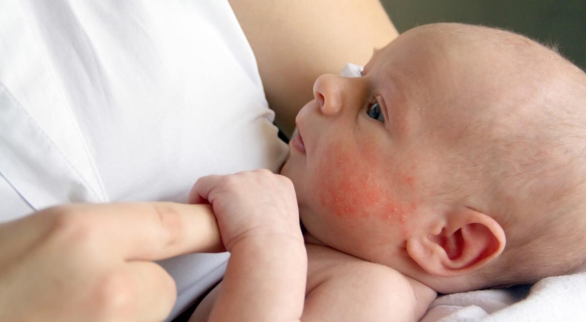 аллергия у новорожденного