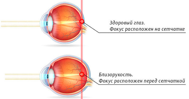близорукость в сравнении со здоровым
