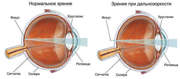 Как вылечить быстро дальнозоркость