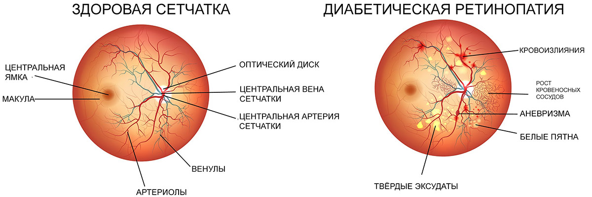 У больных сахарным диабетом риск полной потери зрения выше в целых 25 раз