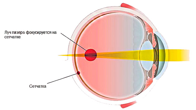 Как вылечить прогрессирующую миопию thumbnail