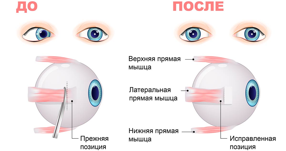 После операции на косоглазие болит глаз