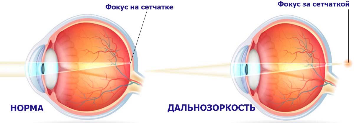 дальнозоркость является врожденным нарушением в работе преломляющей системы глазного яблока